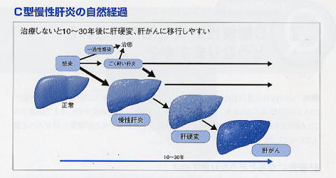 インターフェロンは怖い 効かない 益田市医師会